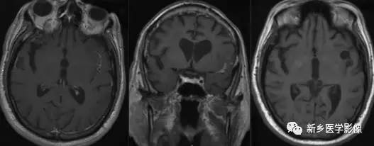 8种软脑膜强化的病变汇总 8种软脑膜强化的病变汇总