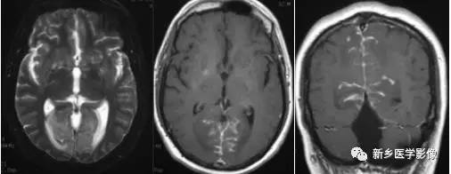 8种软脑膜强化的病变汇总 8种软脑膜强化的病变汇总