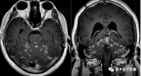 8种软脑膜强化的病变汇总 8种软脑膜强化的病变汇总