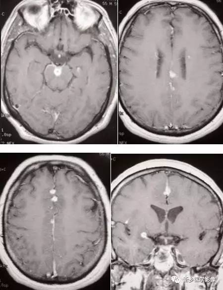8种软脑膜强化的病变汇总 8种软脑膜强化的病变汇总