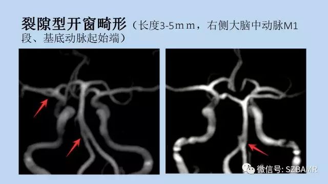 【PPT】脑动脉正常变异MRA总结