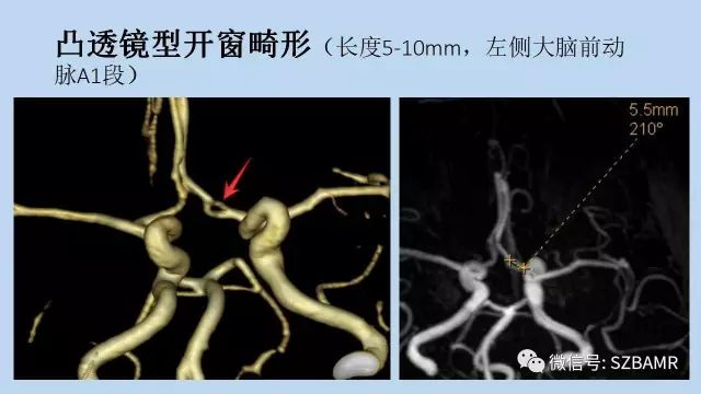 【PPT】脑动脉正常变异MRA总结