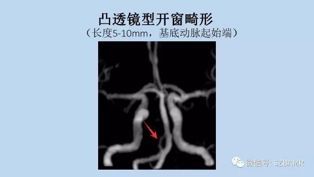 【PPT】脑动脉正常变异MRA总结
