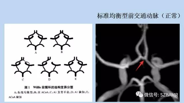 【PPT】脑动脉正常变异MRA总结