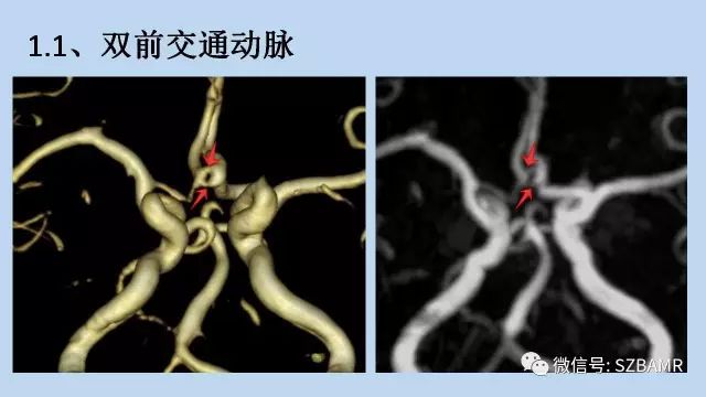 【PPT】脑动脉正常变异MRA总结