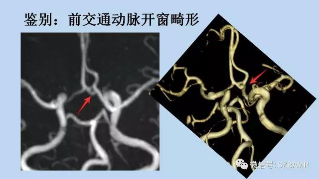 【PPT】脑动脉正常变异MRA总结