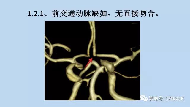 【PPT】脑动脉正常变异MRA总结