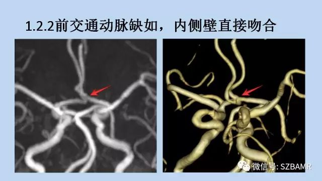 【PPT】脑动脉正常变异MRA总结