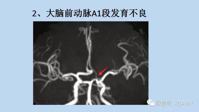 【PPT】脑动脉正常变异MRA总结