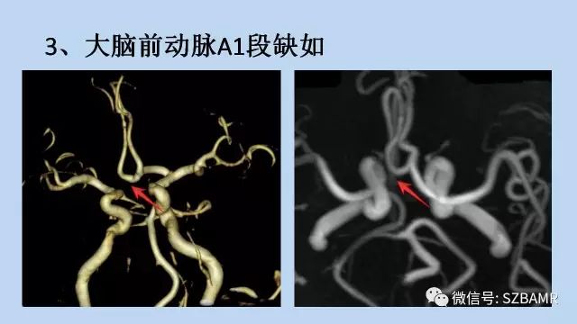 【PPT】脑动脉正常变异MRA总结