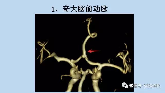 【PPT】脑动脉正常变异MRA总结