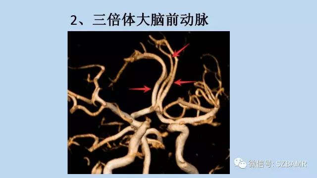【PPT】脑动脉正常变异MRA总结
