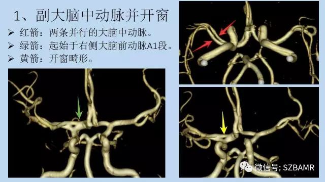 【PPT】脑动脉正常变异MRA总结