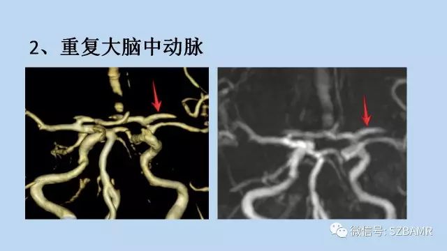【PPT】脑动脉正常变异MRA总结