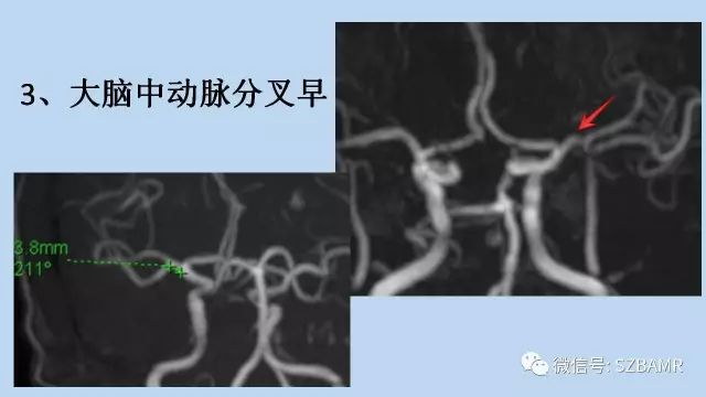 【PPT】脑动脉正常变异MRA总结