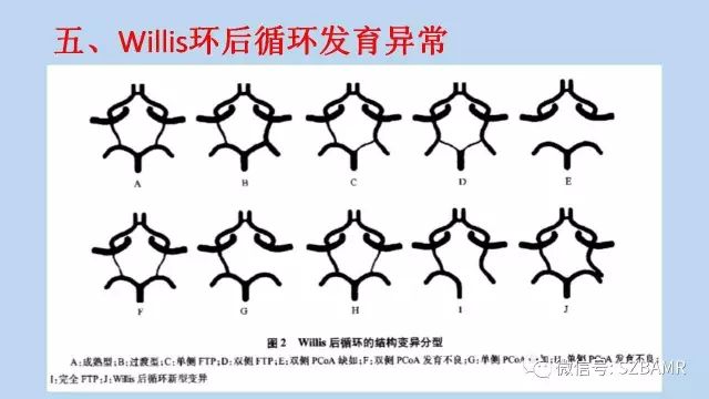 【PPT】脑动脉正常变异MRA总结