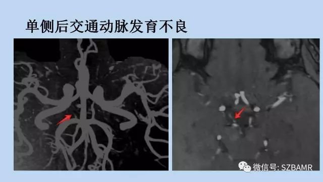 【PPT】脑动脉正常变异MRA总结