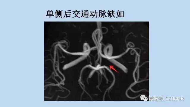 【PPT】脑动脉正常变异MRA总结