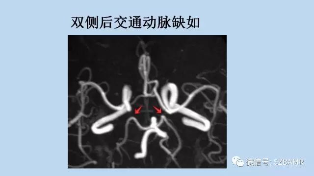 【PPT】脑动脉正常变异MRA总结