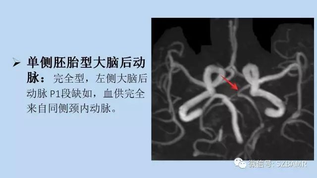 【PPT】脑动脉正常变异MRA总结