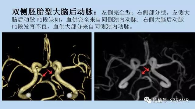 【PPT】脑动脉正常变异MRA总结