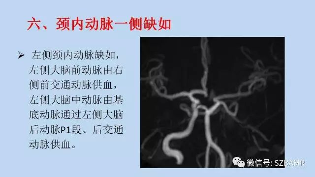 【PPT】脑动脉正常变异MRA总结