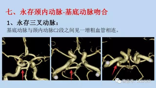 【PPT】脑动脉正常变异MRA总结