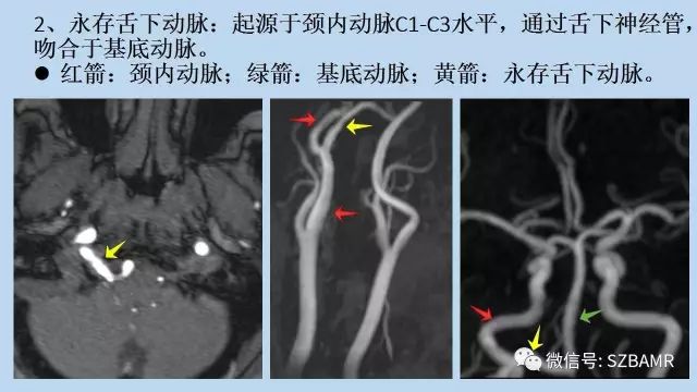 【PPT】脑动脉正常变异MRA总结