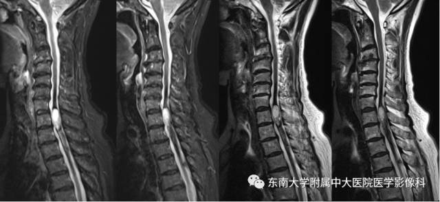 【病例】神经纤维瘤病1例MR