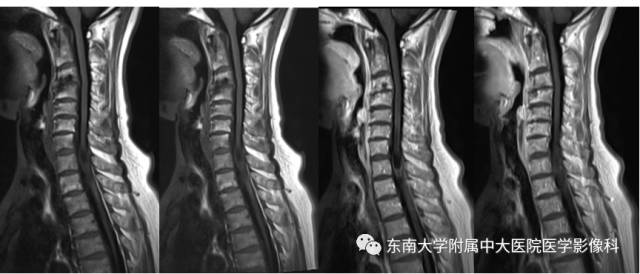 【病例】神经纤维瘤病1例MR