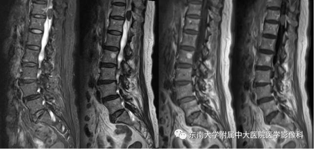 【病例】神经纤维瘤病1例MR