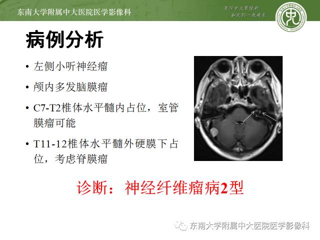 【病例】神经纤维瘤病1例MR