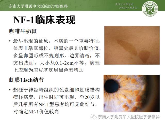 【病例】神经纤维瘤病1例MR