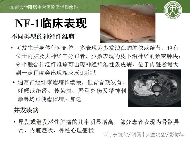 【病例】神经纤维瘤病1例MR