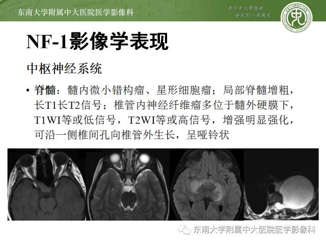 【病例】神经纤维瘤病1例MR