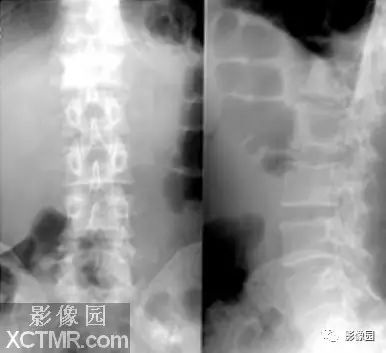 【病例】椎体转移瘤1例CT 【病例】椎体转移瘤1例CT
