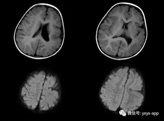 【病例】脑裂畸形、灰质异位1例MR 【病例】脑裂畸形、灰质异位1例MR