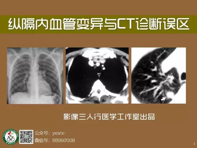【PPT】纵隔内血管变异与CT诊断误区