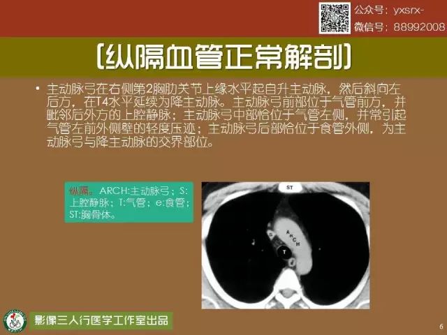 【PPT】纵隔内血管变异与CT诊断误区 【PPT】纵隔内血管变异与CT诊断误区