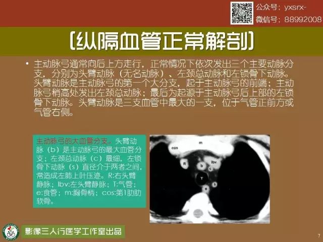 【PPT】纵隔内血管变异与CT诊断误区 【PPT】纵隔内血管变异与CT诊断误区