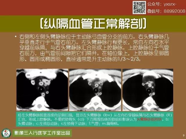 【PPT】纵隔内血管变异与CT诊断误区 【PPT】纵隔内血管变异与CT诊断误区