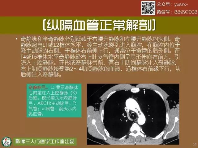 【PPT】纵隔内血管变异与CT诊断误区 【PPT】纵隔内血管变异与CT诊断误区