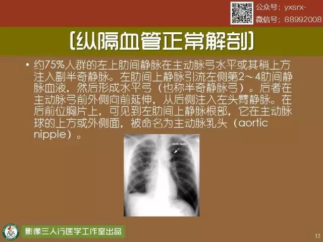 【PPT】纵隔内血管变异与CT诊断误区 【PPT】纵隔内血管变异与CT诊断误区