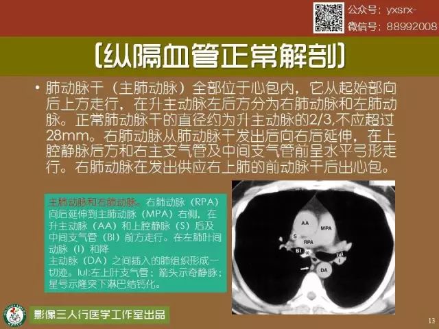 【PPT】纵隔内血管变异与CT诊断误区 【PPT】纵隔内血管变异与CT诊断误区