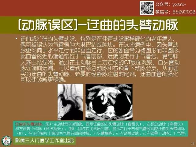 【PPT】纵隔内血管变异与CT诊断误区 【PPT】纵隔内血管变异与CT诊断误区