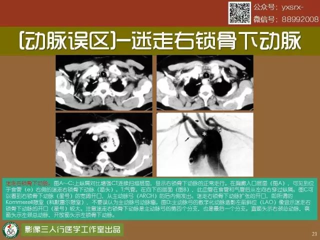 【PPT】纵隔内血管变异与CT诊断误区 【PPT】纵隔内血管变异与CT诊断误区