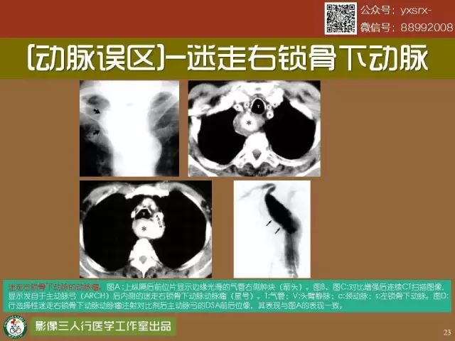 【PPT】纵隔内血管变异与CT诊断误区 【PPT】纵隔内血管变异与CT诊断误区