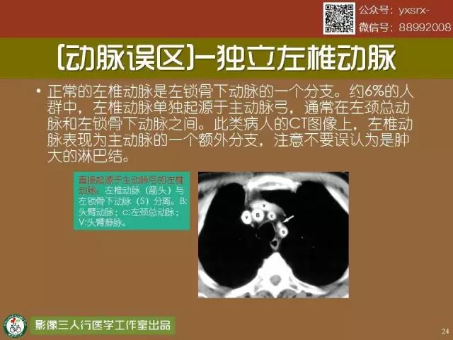 【PPT】纵隔内血管变异与CT诊断误区 【PPT】纵隔内血管变异与CT诊断误区