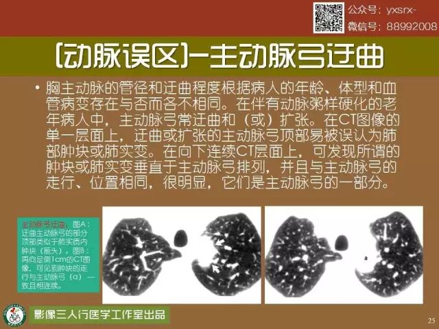 【PPT】纵隔内血管变异与CT诊断误区 【PPT】纵隔内血管变异与CT诊断误区