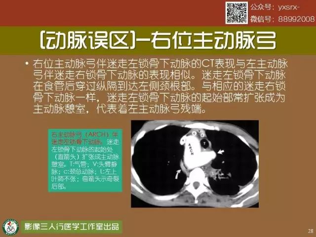 【PPT】纵隔内血管变异与CT诊断误区 【PPT】纵隔内血管变异与CT诊断误区